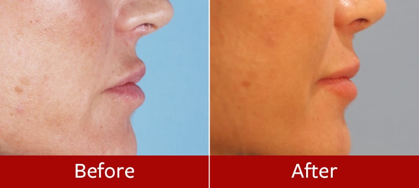 Before-and-after-lip