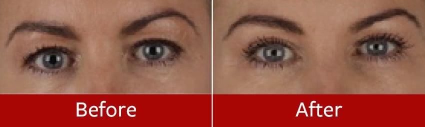 Blepharoplasty-before-and-after