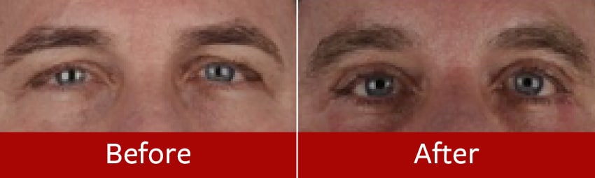 Blepharoplasty-before-and-after2