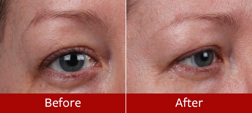 Brow-Lift-before-and-after