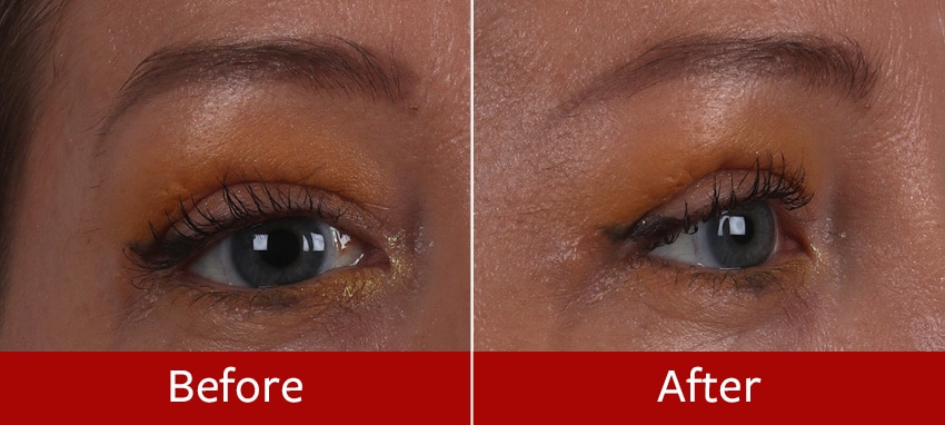 Brow-Lift-before-and-after2