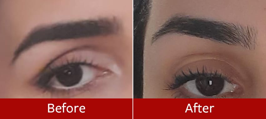 Brow-Lift-before-and-after3