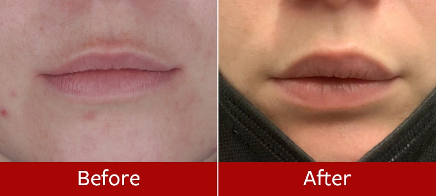 Lip-lift-before-and-after2
