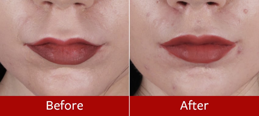 Lip-lift-before-and-after3