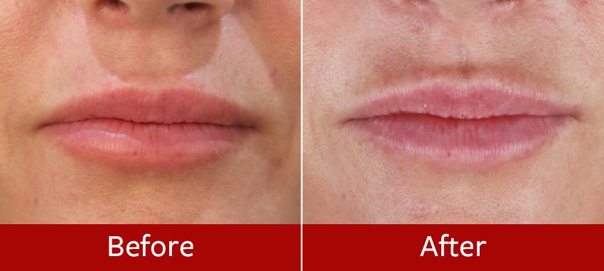 Lip-lift-before-and-after4