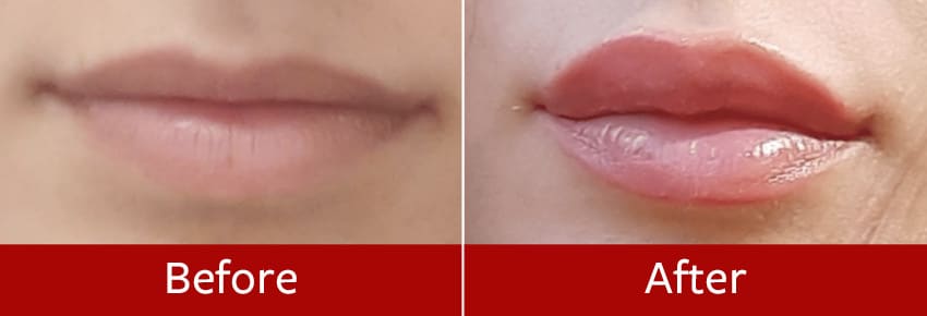 Lip-lift-before-and-after6