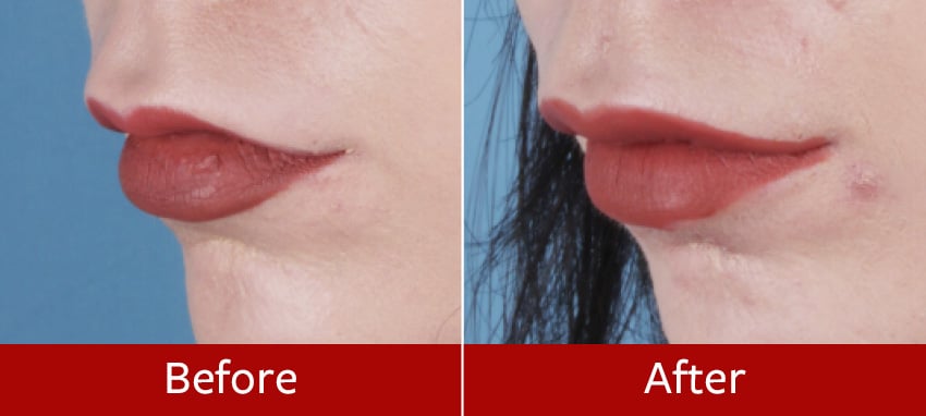 Lip-lift-before-and-after7