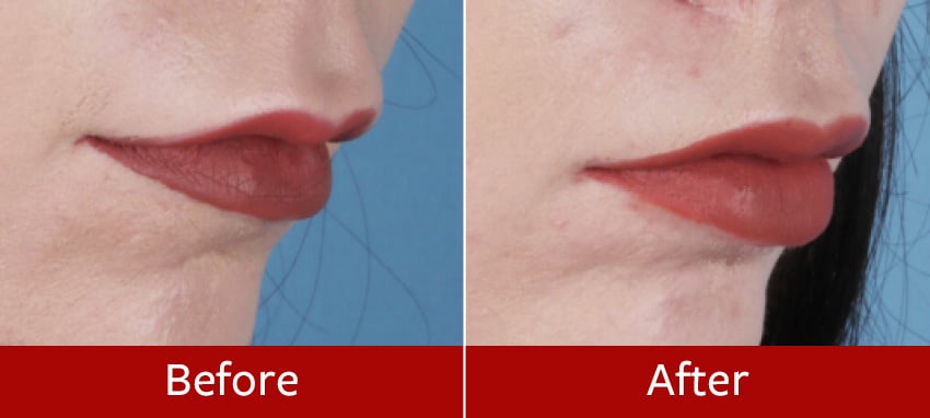 Lip-lift-before-and-after8